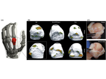 Towards entry "Early detection of arthritis using artificial intelligence"